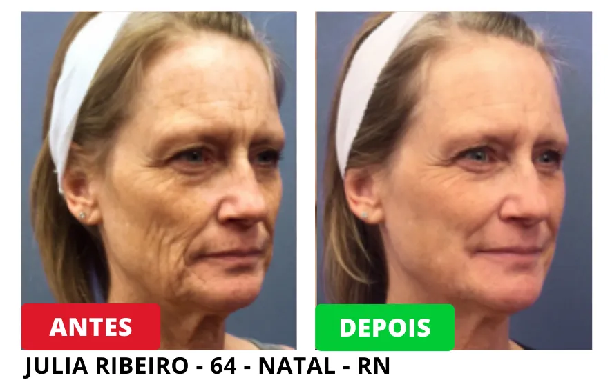 antes de depois