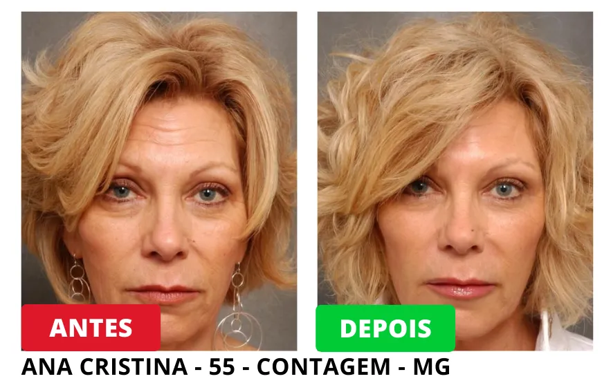 antes e depois