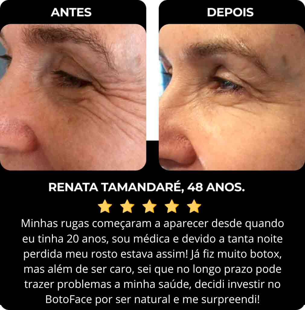 Botoface antes de depois