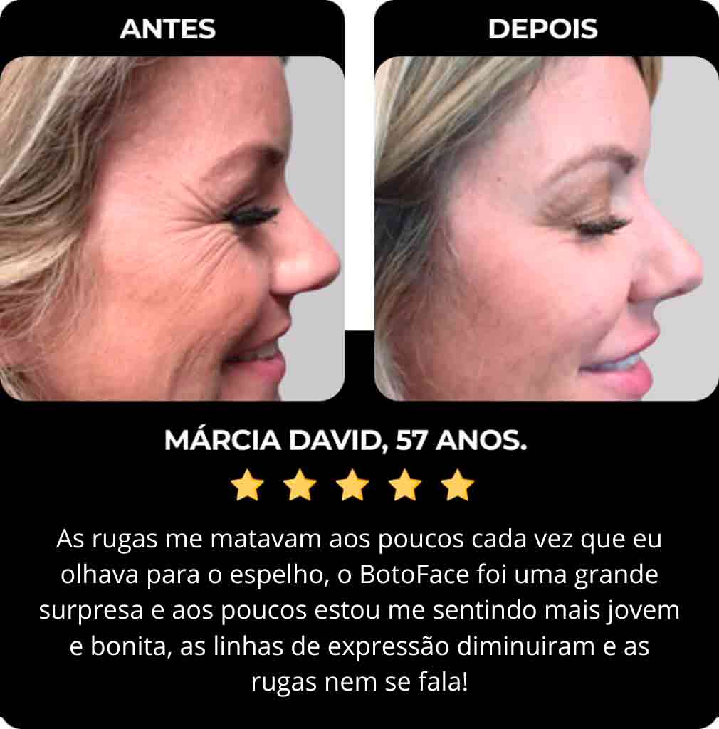 Botoface antes de depois
