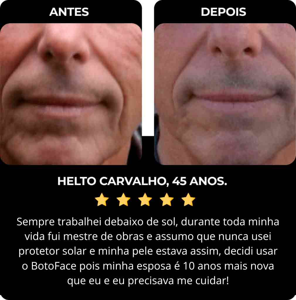 Botoface antes de depois